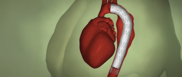 Stroke Treatment